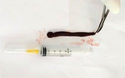 Ra khe suối tắm, bé 4 tuổi bị đỉa dài 10cm chui vào trong mũi