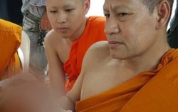 Bé gái 8 tháng mù, hở hàm ếch và không có hộp sọ 