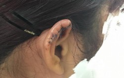 Nữ giáo viên khiêu vũ tố bị phụ huynh cắn đứt tai