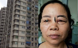 Hà Nội: Thêm một vụ nhân viên vệ sinh bị đấm tím mắt