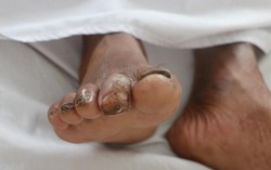 Phát hiện thêm nhiều bệnh nhân nhiễm vi khuẩn ăn thịt người