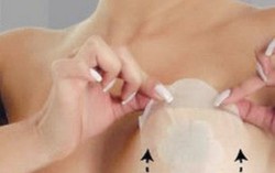Miếng dán nâng ngực có thể gây vẹo 'núi đôi'