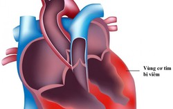 Bộ Y tế lên tiếng về virus lây lan bệnh Viêm cơ tim