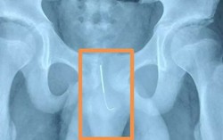 Cậu bé 12 tuổi nhét kim châm cứu vào dương vật để... tỉnh ngủ