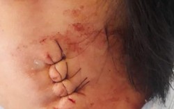 Vụ chẩn đoán viêm hạch, mổ không thấy hạch: Gia đình rút đơn khiếu nại
