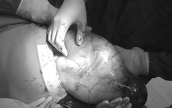 Bác sĩ bất ngờ vì em bé chào đời còn nguyên trong bọc ối