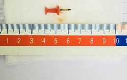 Bé gái 12 tuổi ho ra máu vì nuốt phải đinh ghim