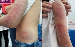 Bố say rượu đánh con gái 6 tuổi nhập viện