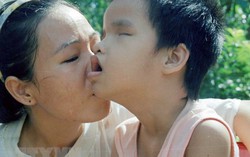 Hình ảnh lay động con tim về những nạn nhân da cam/dioxin