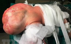 Bóc tách khối u quái khổng lồ bằng nửa trọng lượng trẻ sơ sinh