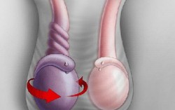 Bất ngờ đau bụng, đi khám thì bị xoắn tinh hoàn
