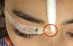 Kim khâu biến mất khi nhấn mí chìm tại cơ sở làm đẹp tư