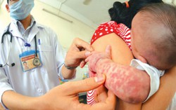 Dịch sởi bùng phát trên thế giới, người dân phòng tránh thế nào?