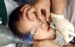 Bé 2 tuổi ngừng thở, ngừng tim do ăn thạch rau câu