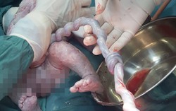 Trẻ sơ sinh bị thắt nút 2 vòng dây rốn nguy hiểm tính mạng nếu không can thiệp kịp thời