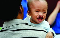 Phẫu thuật miễn phí nhiều trẻ dị tật khe hở môi, hở hàm ếch