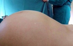 Cụ ông 84 tuổi mang u khổng lồ như bà bầu 9 tháng