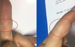 Sưng ngón tay không đi khám, nữ bệnh nhân mắc u tế bào khổng lồ hiếm gặp