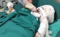 Tự nấu mỳ tôm, bé 7 tuổi bỏng nặng
