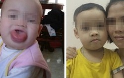  'Đánh tan' lưỡi phì đại không cần phẫu thuật