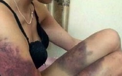 Cô gái bị người yêu đánh bầm dập vì ghen