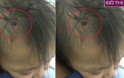Qua nhà hàng xóm chơi, bé gái 19 tháng tuổi bị cắm đinh vít vào đầu