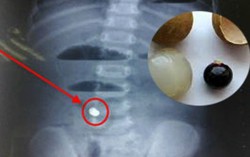 Trẻ 2 tuổi phải sống thực vật vì hóc hạt nhãn do bất cẩn của người lớn