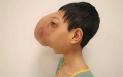 Thay đổi kỳ diệu của cậu bé có khuôn mặt lạ