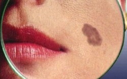 Những hiểu lầm về ung thư da bạn nên biết