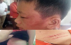 Điều tra vụ nữ giáo viên tiểu học bạo hành con riêng của chồng nhập viện
