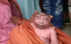 Cậu bé mắc bệnh lạ có thân hình giống khỉ