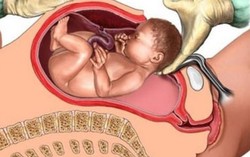 Sản phụ bất ngờ bị sốc phản vệ nguy hiểm tính mạng sau khi sinh mổ