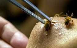 Sốc nặng, hôn mê do bị ong vò vẽ đốt hơn 20 nốt