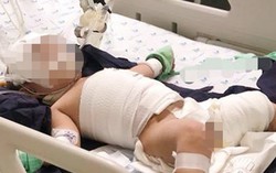 Bé gái bị bỏng nặng vì vấp ngã vào bình nước sôi siêu tốc