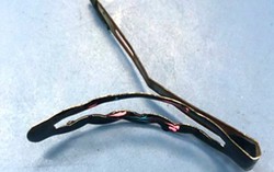Bé gái bị thủng tá tràng do nuốt phải kẹp tóc