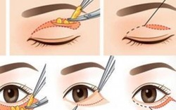 Cắt mí mắt và nâng mũi tại spa, nguy hiểm thế nào?
