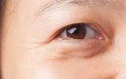 7 phương pháp hạn chế tối đa nỗi lo nếp nhăn