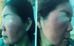 Mặt sưng tấy vì tự mua thuốc đông y trị nám