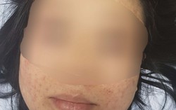 Sản phụ hoảng hốt khi bị xuất huyết dưới da vùng mặt sau khi sinh