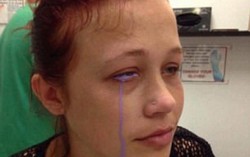 Xăm tròng mắt, cô gái có nguy cơ bị mù khi khóc ra mực tím