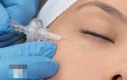 Spa tiêm filler cho người phụ nữ dẫn đến mù mắt hoạt động không phép