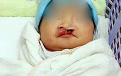 Xót xa bé gái sơ sinh hở hàm ếch bị bỏ rơi giữa chợ