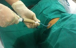 Cứu bệnh nhân bị viêm thận bể thận ứ mủ