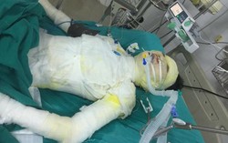 Gã trai tàn độc tẩm xăng đốt bạn gái bỏng 92% cơ thể