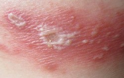 Cách phân biệt vết thương do kiến ba khoang và bệnh Zona thần kinh