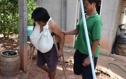 Ngực to bất thường, người phụ nữ phải dùng nạng di chuyển