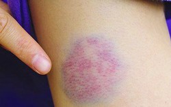6 nguyên nhân phổ biến gây các vết bầm tím trên cơ thể
