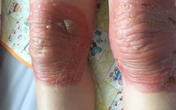 Bó thuốc Nam, người phụ nữ bị ‘bỏng’ 2 đầu gối