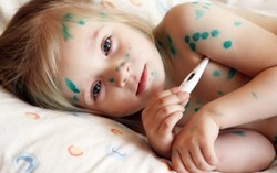 Chuyên gia mách mẹ chăm sóc con bị thủy đậu