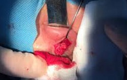 Gắp giun dài 6cm ngoe nguẩy trong hốc mắt